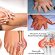 Illustration for article titled Obat Asam Urat Apa Sajaem/em